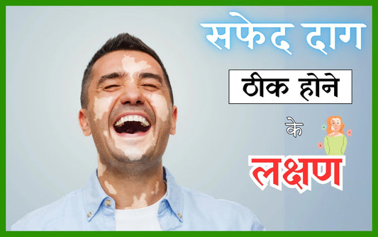 सफेद दाग ठीक होने के लक्षण, safed daag ke lakshan