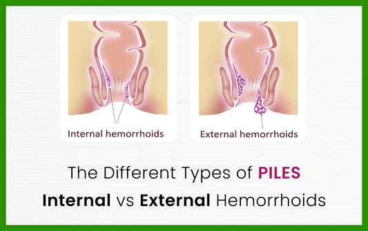 The Different Types of Piles: Internal vs. External Hemorrhoids