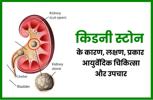 किडनी स्टोन के कारण, लक्षण, प्रकार, आयुर्वेदिक चिकित्सा और उपचार