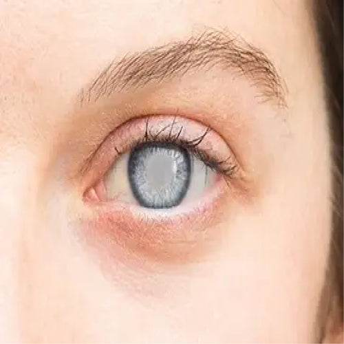 Prevents Cataract & Glaucoma