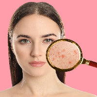 Reduces blemishes & dark spots