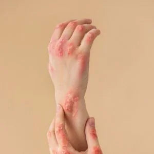 Reduces Redness & Inflammation