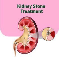 Kidney Stone