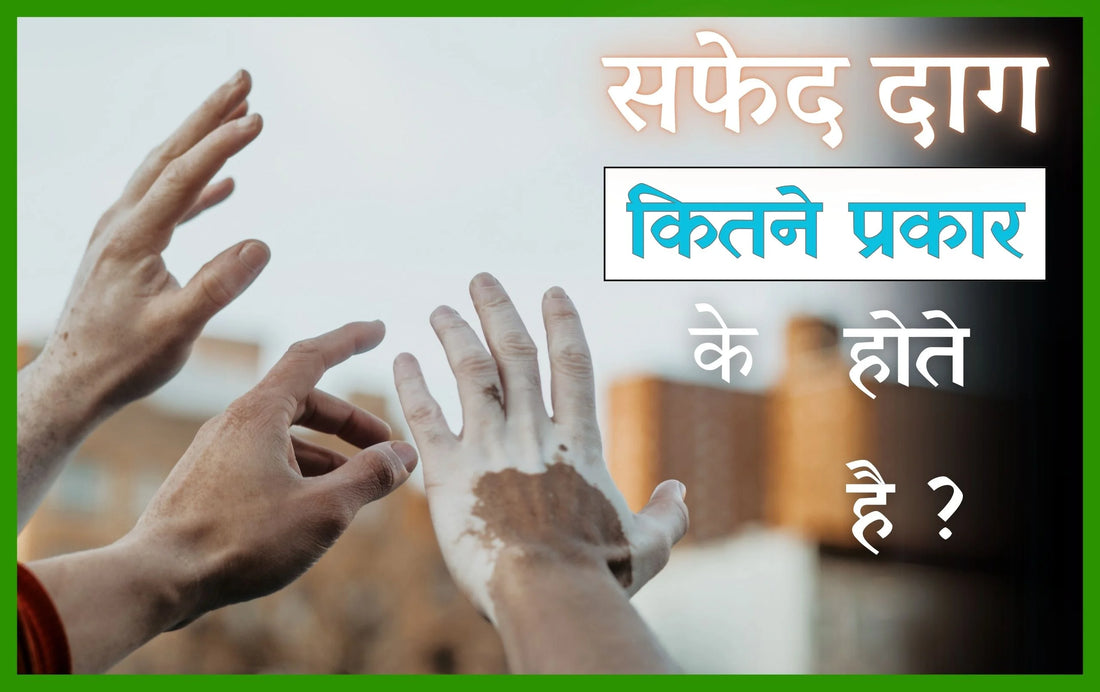 सफेद दाग कितने प्रकार के होते है, शुरुआती लक्षण सफेद दाग कितने प्रकार के होते है, सफेद दाग के प्रकार