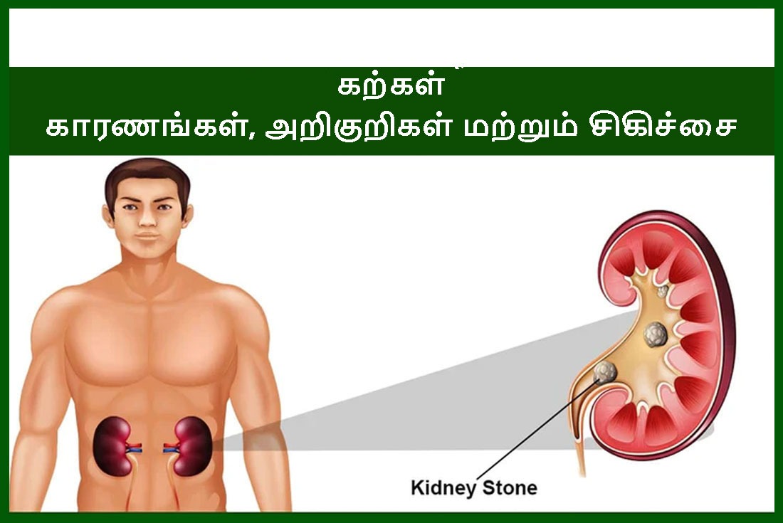 சிறுநீரக கல் காரணங்கள், அறிகுறிகள், வகைகள், ஆயுர்வேத மருத்துவம் மற்றும் சிகிச்சை