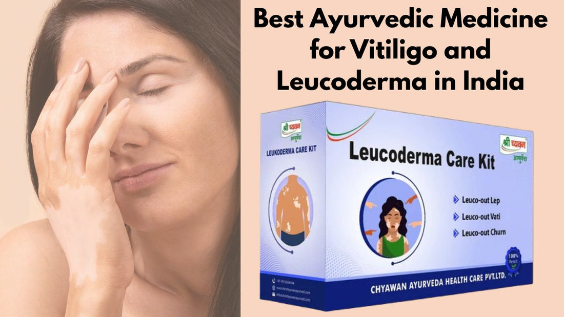 Ayurvedic Medicine for Vitiligo