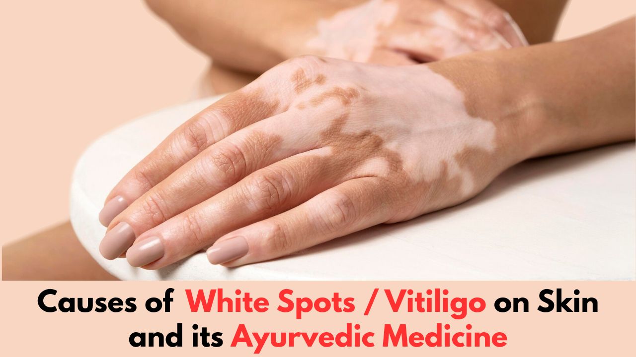 Causes of White Spots / Vitiligo on Skin and its Ayurvedic Medicine
