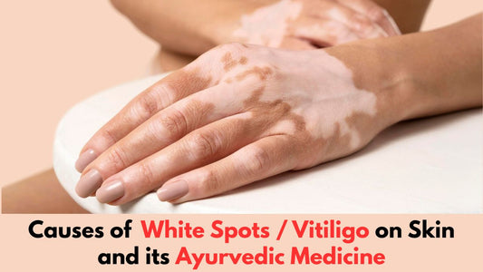 ayurvedic medicine for vitiligo