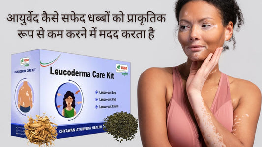 Vitiligo Ayurvedic Treatment