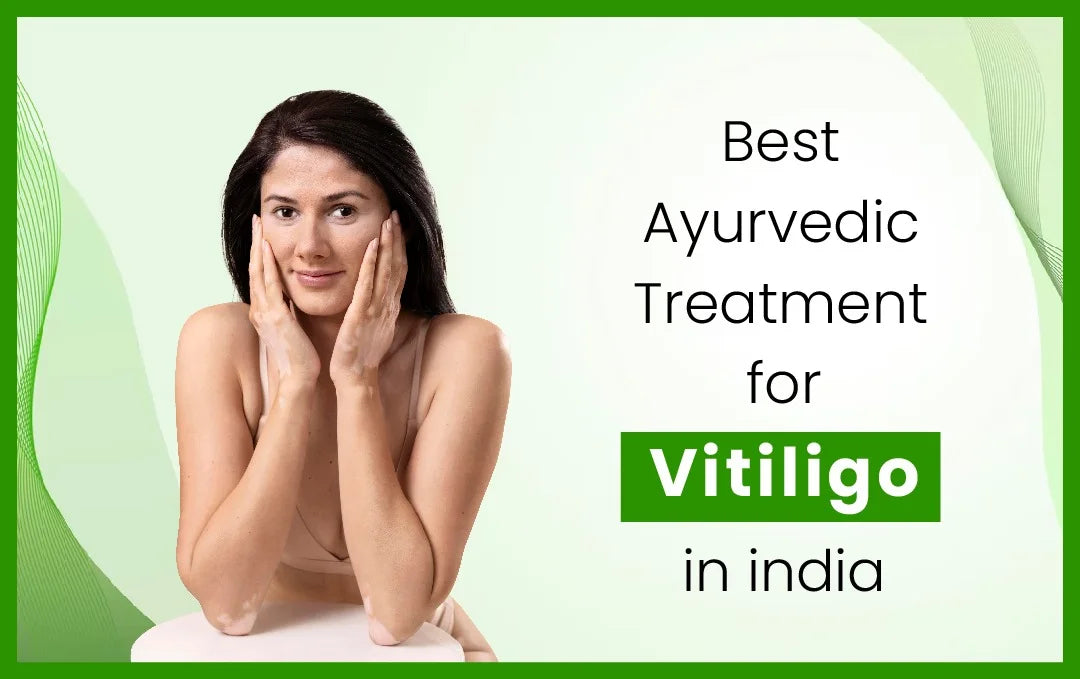 Best Ayurvedic Treatment for Vitiligo, vitiligo treatment in ayurveda, vitiligo ayurveda treatment, best ayurvedic medicine for vitiligo,
