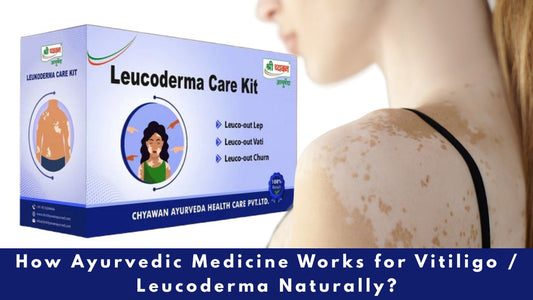 ayurvedic medicine for vitiligo