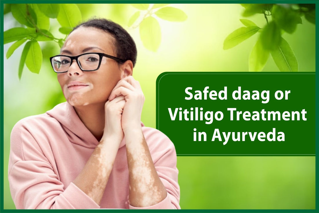 ayurvedic treatment for vitiligo