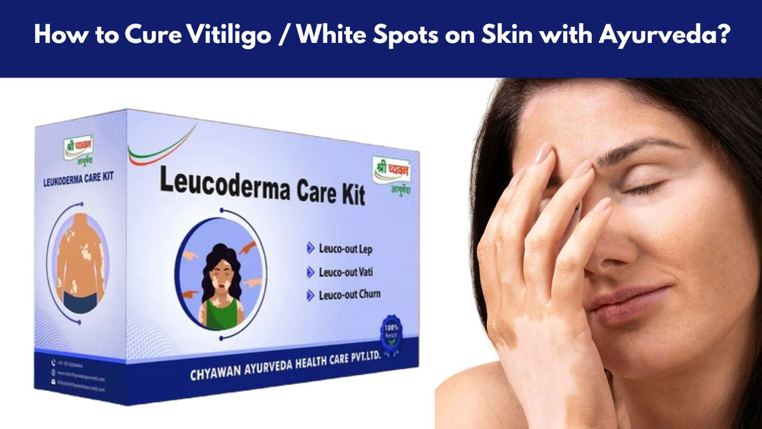 Ayurvedic Medicine for Vitiligo