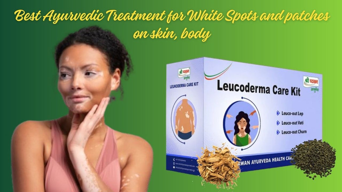 ayurvedic treatment for white patches on skin