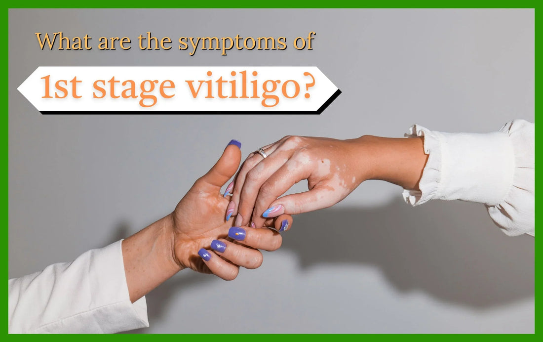 starting symptoms of vitiligo