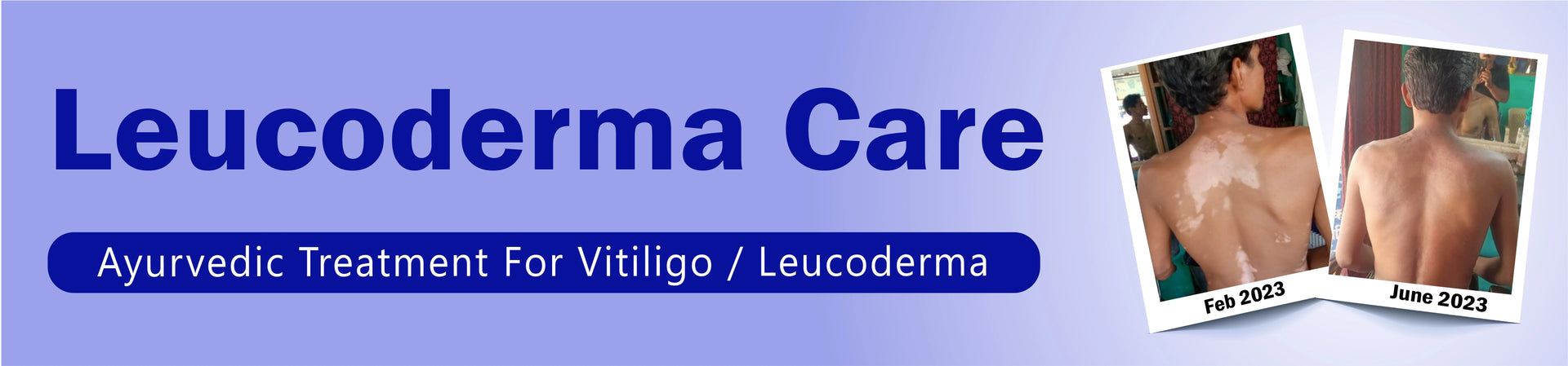 Vitiligo Ayurvedic Medicine & Treatment - Leukoderma Care