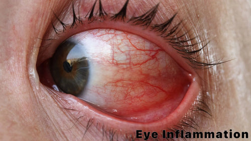 Help Relieve Eye Redness
