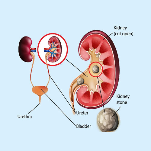 Promotes natural kidney stone dissolution