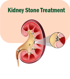 Kidney Stone